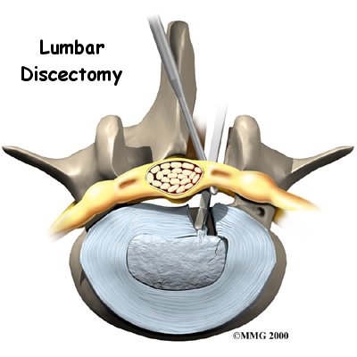 Lumbar Discectomy